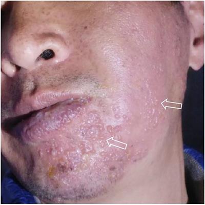 Ramsay Hunt syndrome and mandibular alveolar bone necrosis following herpes zoster: A case report and literature review